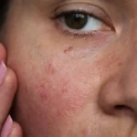 Herbal Remedies for Sensitive Skin Irritation