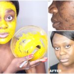 Natural Remedies for Acne Using Kitchen Ingredients