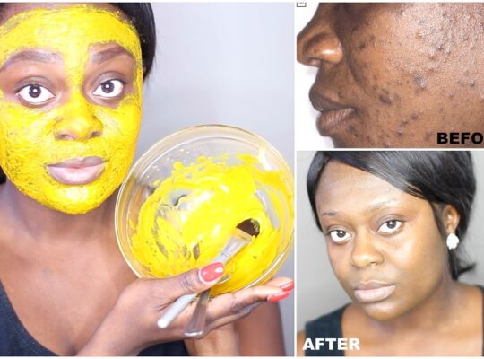 Natural Remedies for Acne Using Kitchen Ingredients