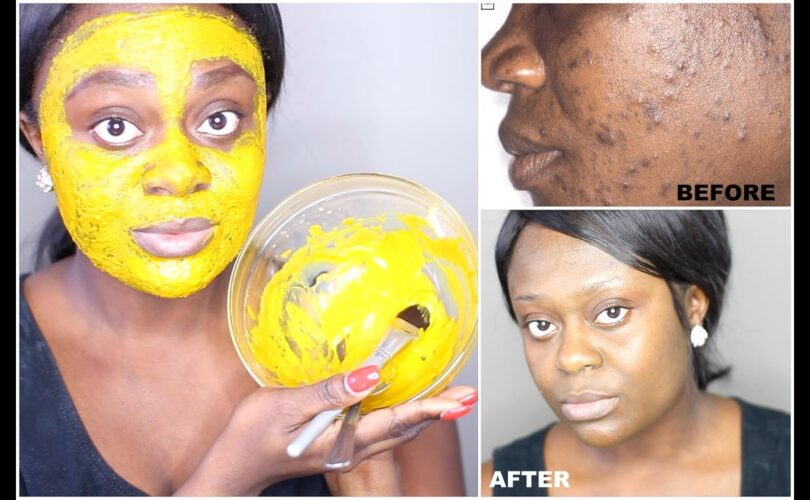Natural Remedies for Acne Using Kitchen Ingredients