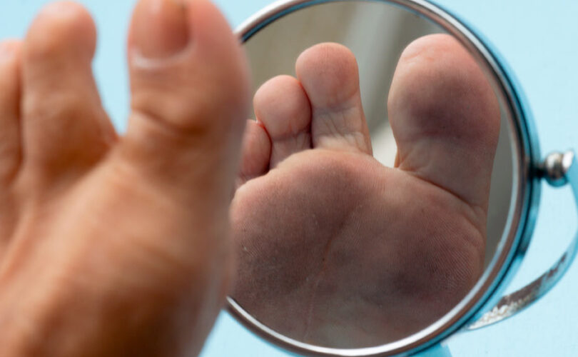 Diabetic Skin Care: Preventing Infections and Dryness 