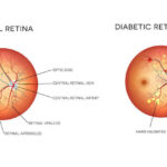 Diabetes and Eye Health: Preventing Retinopathy