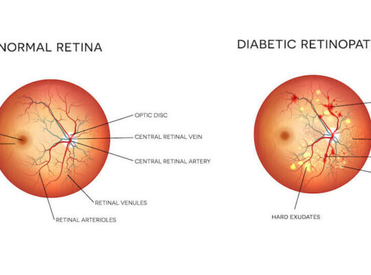 Diabetes and Eye Health: Preventing Retinopathy