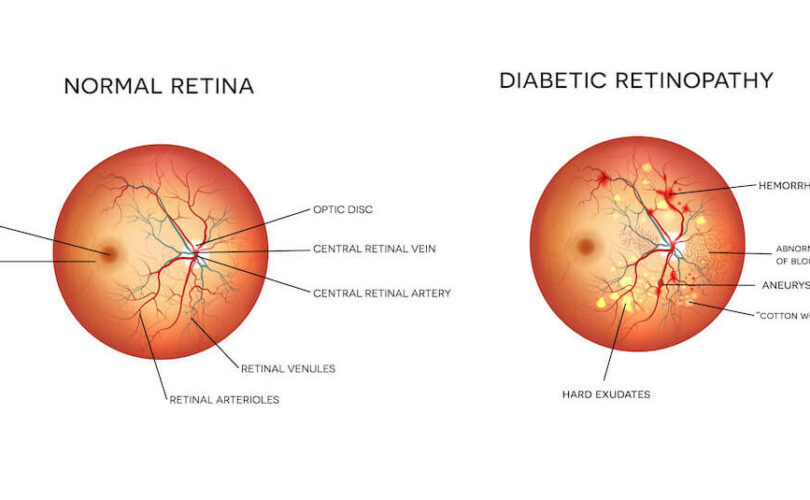 Diabetes and Eye Health: Preventing Retinopathy
